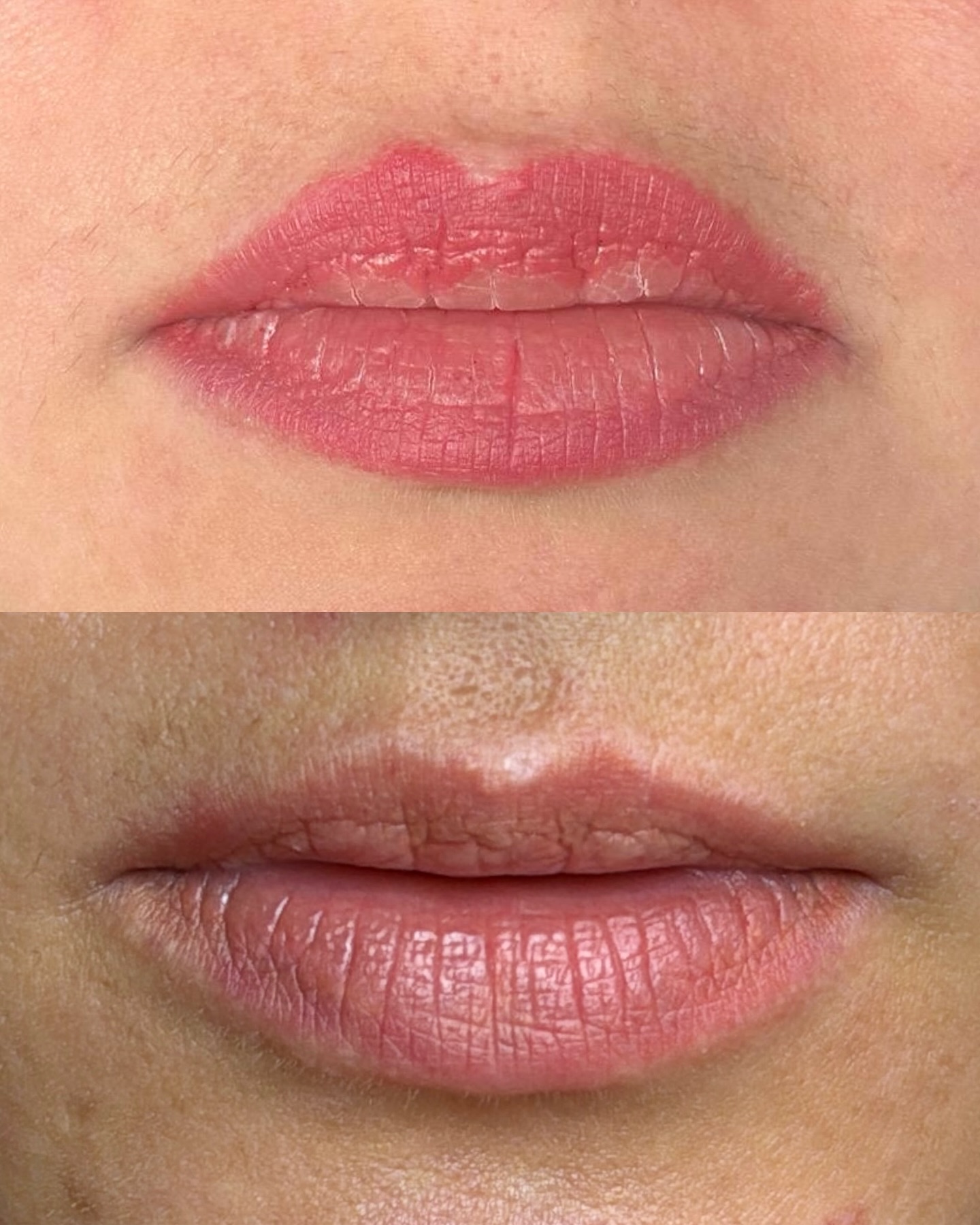 Laser Repair AVIV