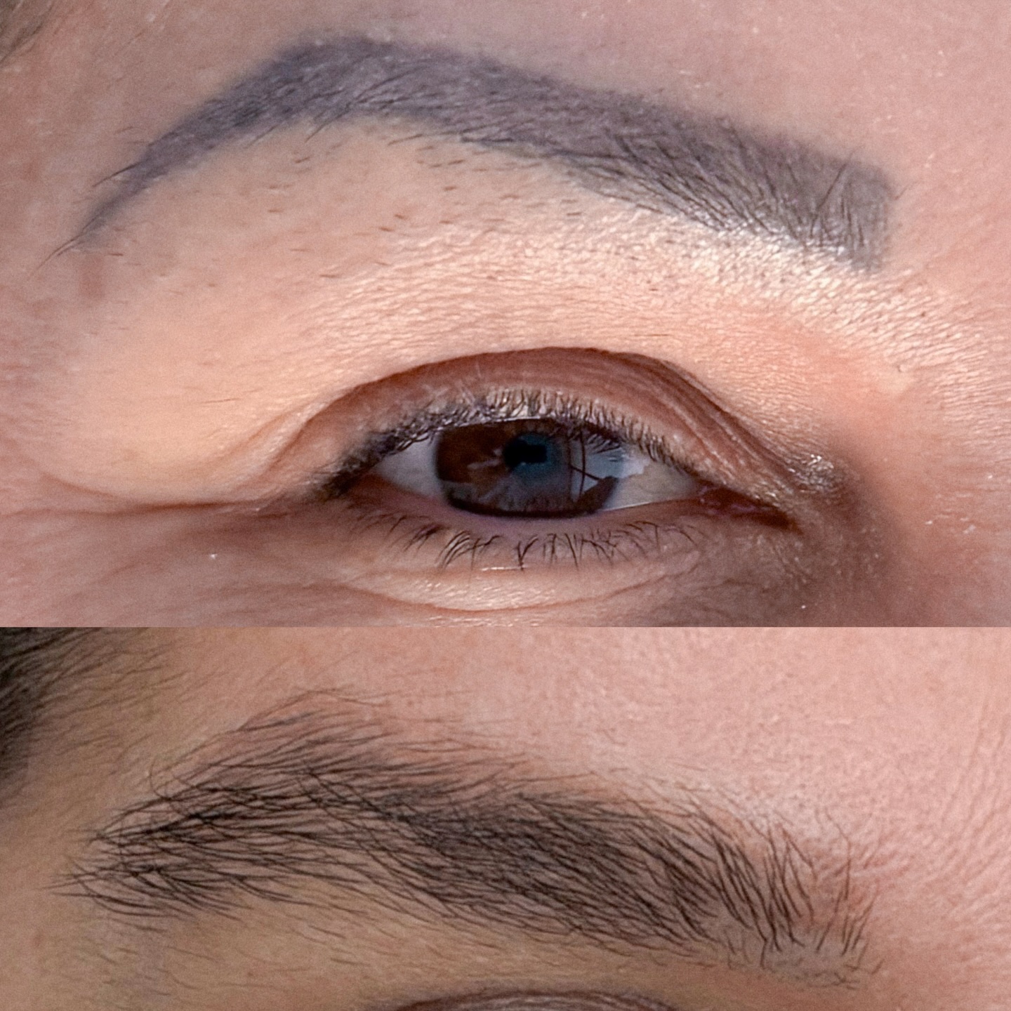 Tratamento Laser