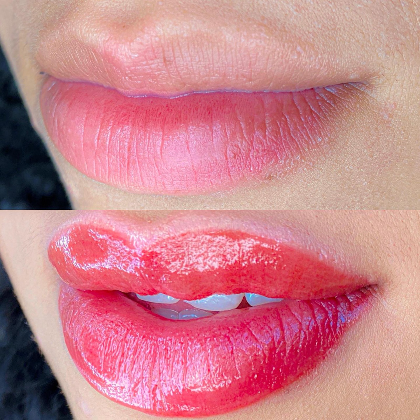 Resultado Micro Labial